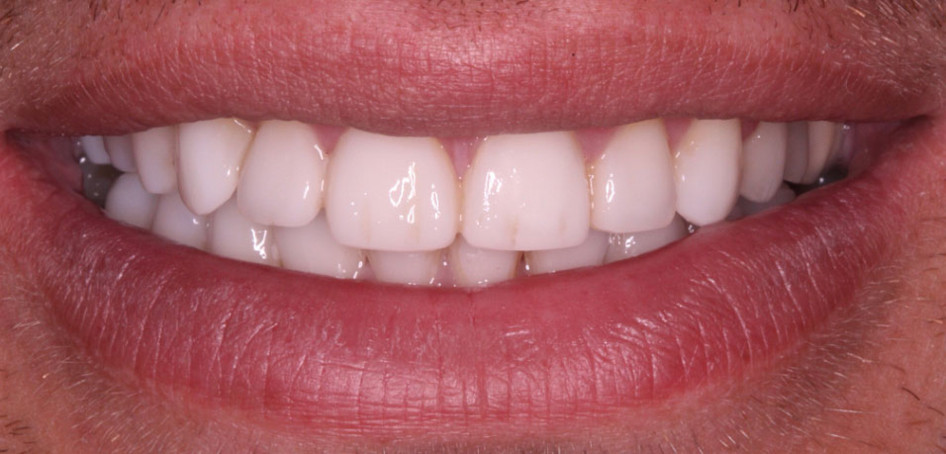 White, fully-formed smile after composite bonding 
